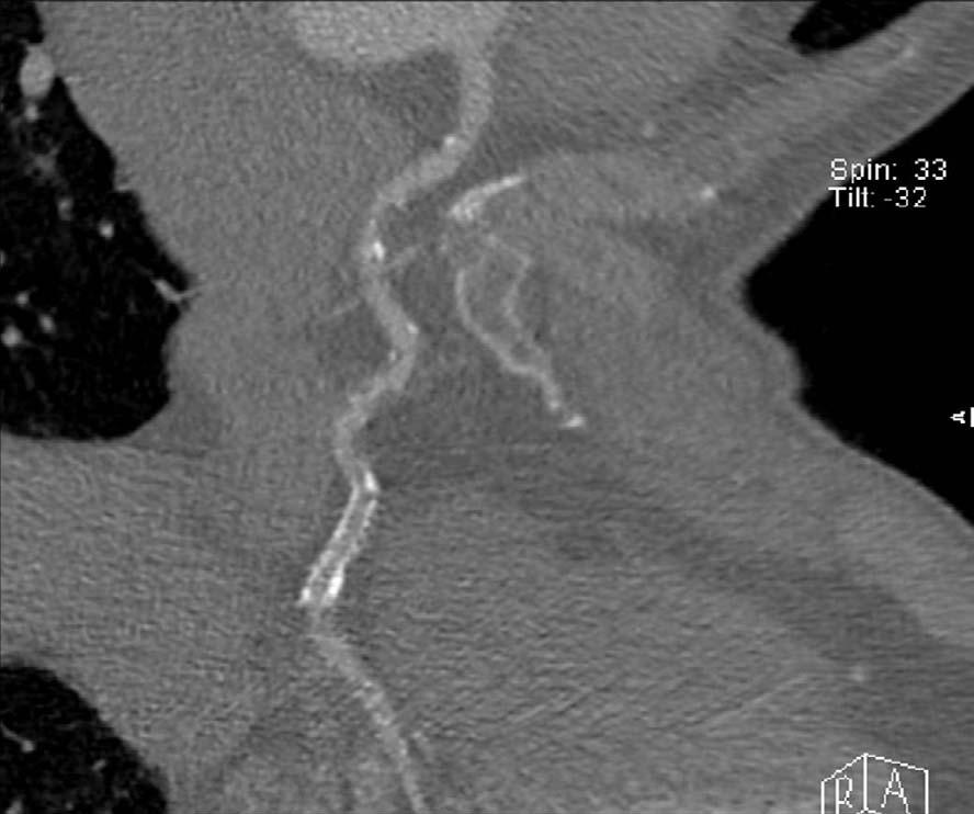 Choi W Figure 4. Instent restenosis in distal right coronary artery.