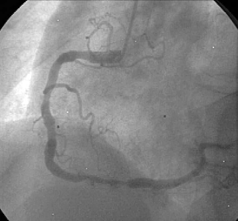 right coronary artery, which was wrongly interpreted as patent ().