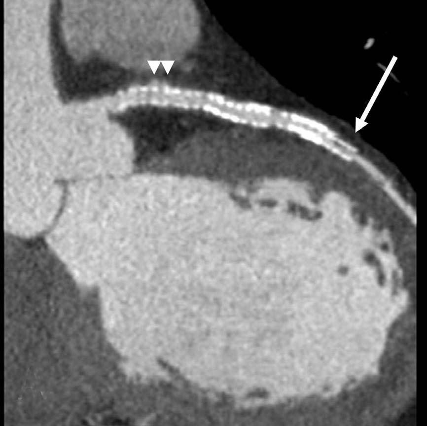 The coronary angiogram confirms instent restenosis ().