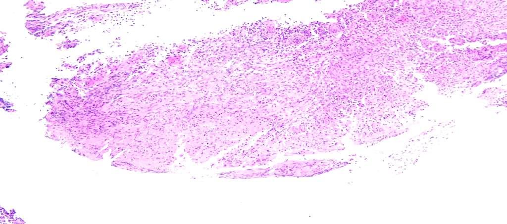 Granuloma Histology Esophagus, 27cm from incisor, endoscopic biopsy: Chronic granulation