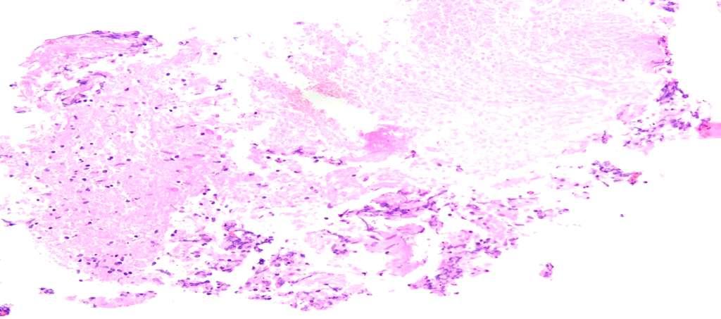 Granuloma Histology Lung, 4R, EBUS-TBNA: Chronic granulomatous inflammation