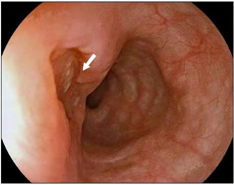 Esophageal tuberculosis Endoscopic findings