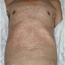 Tuberculosis and Respiratory Diseases Vol. 59. No. 5, Nov. 2005 Figure 1. Skin lesion : Whole body erythematous ma culopapular rash. 사상양측폐하에미만성의폐침윤소견이관찰되었다 (Fig. 2a).