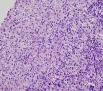 On immuno-histochemical staining, the lymphoid cells are positive for CD3, the T cell marker(c)(x 400). 상태의일시적인호전을보였다. 그러나항암치료 12 일째이후부터호중구감소증과함께다시발열등임상경과및흉부 X-선사진상악화를보여내원 40 일째사망하였다.