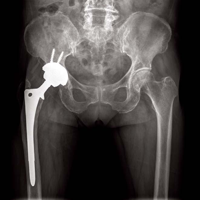 3. Plain X-ray shows insertion state of unipolar antibiotics-mixed cement spacer after femoral