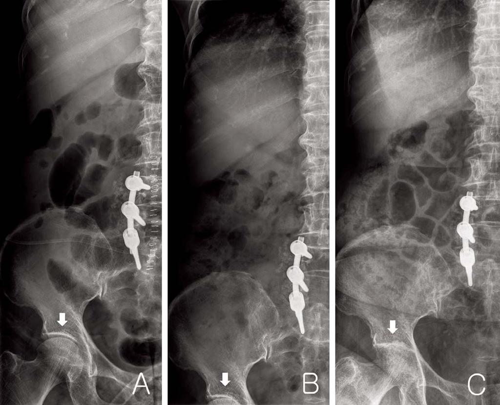 Plain X-ray shows the last follow up after the revision of 2nd stage reimplantation. A B C Fig.