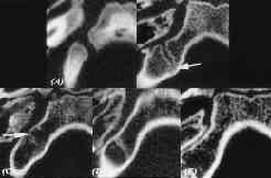 Fig. 3. Five-tier scheme for grading sutural or synchondrosal closure is illustrated along the basioccipital-exoccipital synchondrosis on CT scans. (A) Grade 1.