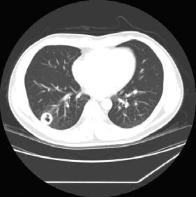 - 이지은외 6 인 : 폐콕시디오이데스진균증 1 예 - Figure 1. Chest CT performed on May-31-2005 shows a 2.5 cm sized well-defined pulmonary nodule with cavitation in the right lower lobe. Figure 2.