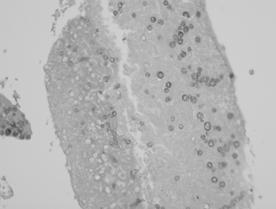 - 대한내과학회지 : 제 72 권부록 2 호 2007 - A B Figure 3. (A, B) Histological section reveals spherules containing endospores (A: H&E staining, 400, B: GMS staining, 400). 으나결절의크기에는변화가없었다 ( 그림 1).