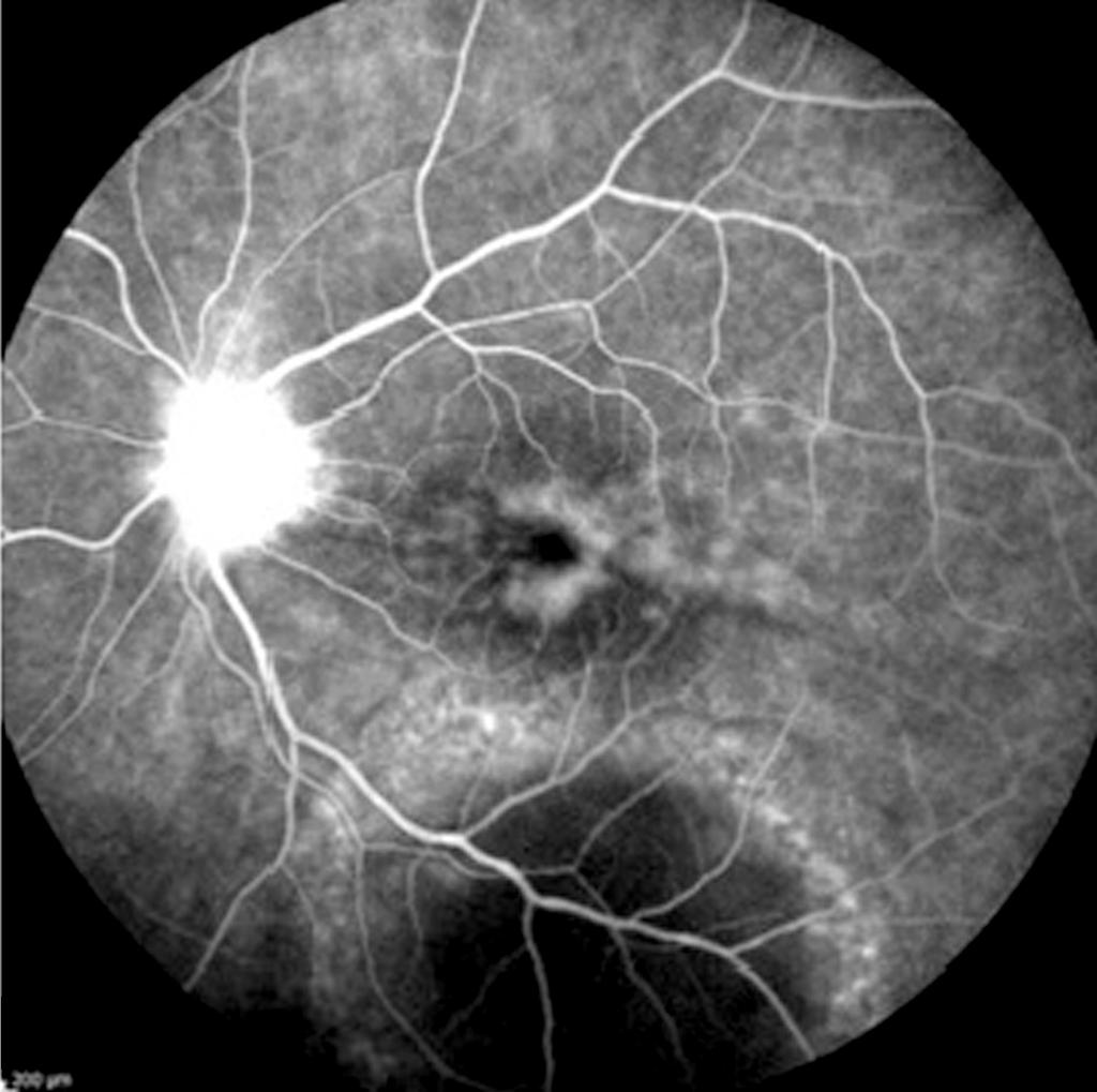 () Late-stage F shows hypofluorescence of the nodule surrounded by a well demarcated