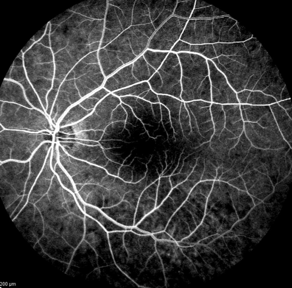 Fluorescein angiography (F) taken at 3 months after treatment.