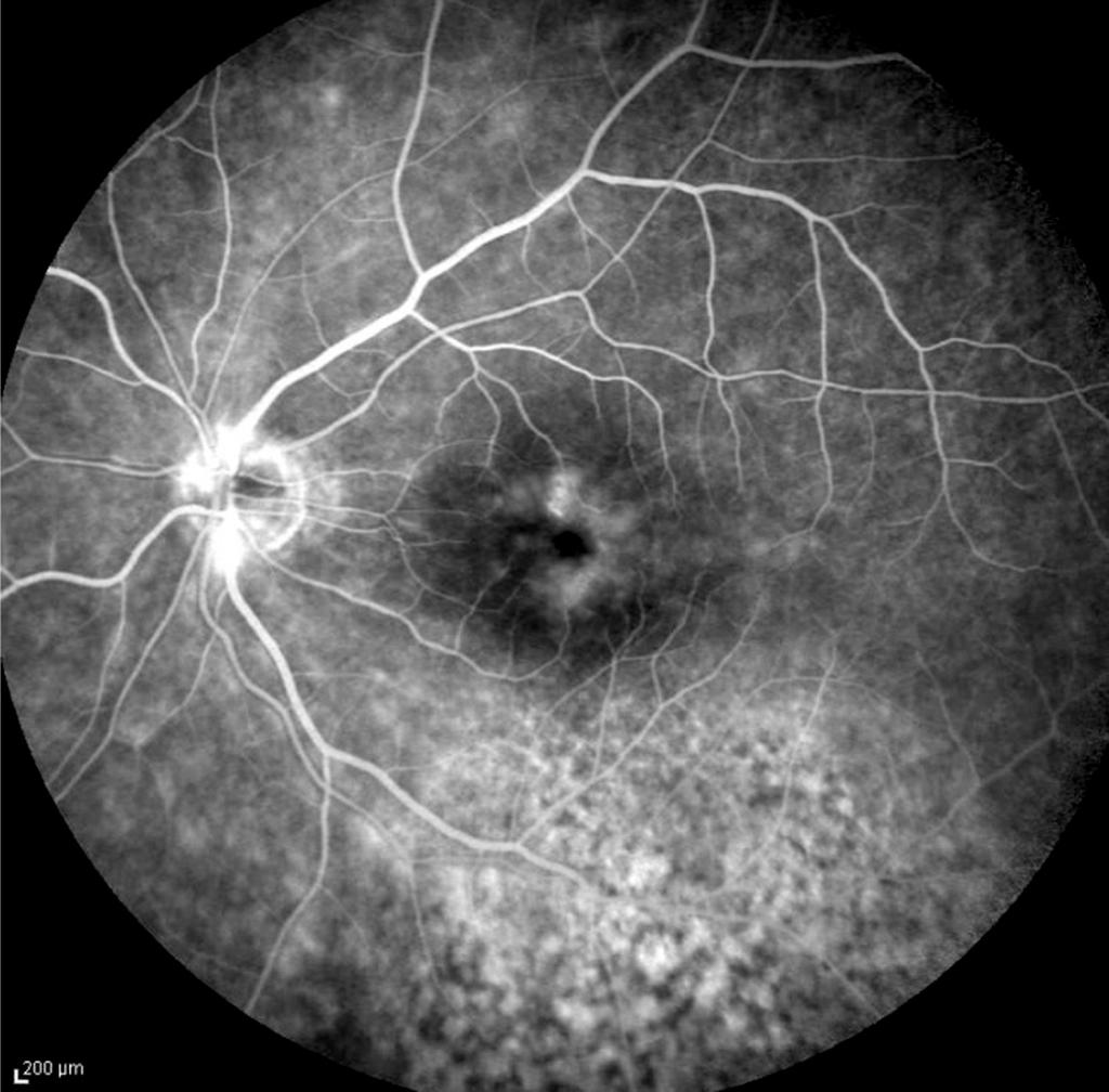 () Late-stage F shows poorly defined hyperfluorescent peripapillary area with hyperfluorescent spots at the macula and mottled hyperfluorescence