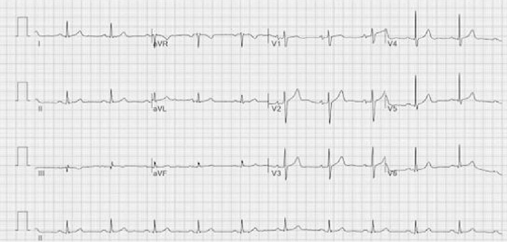 송진철외 5 인 :Atrial flutter after induction 63 Fig. 1. Electrocardiogram taken one day before surgery. Regular sinus rhythm without arrhythmia was observed.