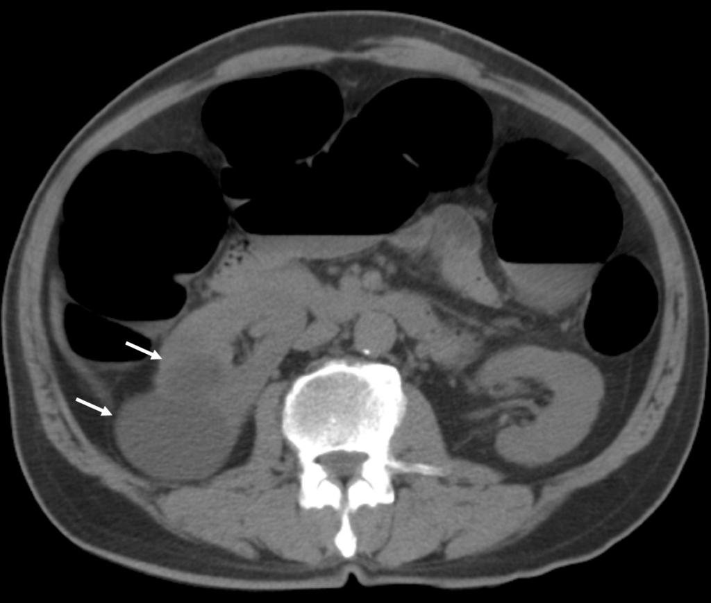 Fig. 3. Asymptomatic 72-year old man with minor importance finding in CT colonography. Non contrast axial CT scan shows about two round cystic lesions (arrows) in right kidney.