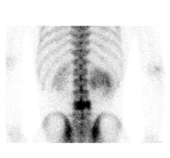 복부와경부의림프절에서시행한조직검사를토대로소포림프종 (follicular lymphoma, grade 2) 을진단받았고 ( 그림 2),