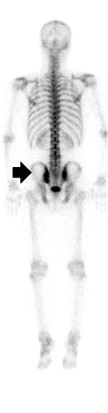 00 mg/dl) 이었고류마티스인자와항핵항체는음성이었으며, HLA-B27은양성이었다. 방사선소견 : 단순흉부방사선검사는정상이었으며, 단순고관절및골반방사선검사에서양측천장관절에경증의경화및골미란이관찰되었고 ( 그림 3) 전신뼈스캔에서왼쪽엉치엉덩관절및왼쪽첫번째발허리 (metatarsal) 관절부위에 Tc-99m MDP의섭취증가소견보였다 ( 그림 4).