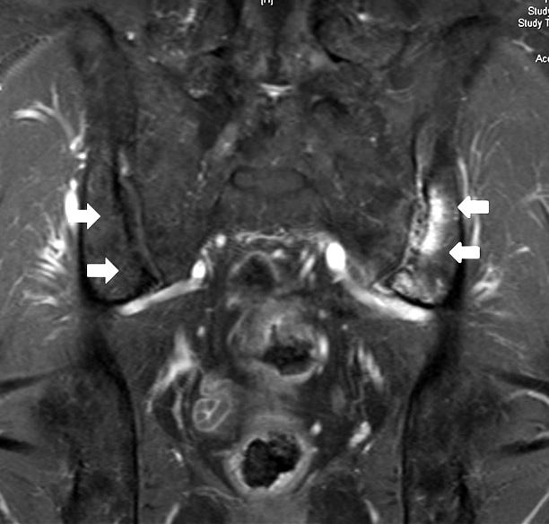 (A) PD fat suppression coronal scan (B) T1-weighted fat suppression with Gadolinium enhancement coronal scan.
