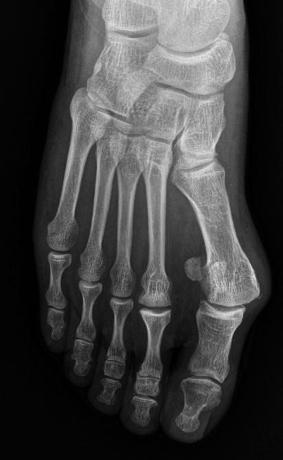 Sanghwan Kim, et al. Modified Mau Osteotomy with Bioabsorbable Screws 99 Table 1. American Orthopaedic Foot and Ankle Society (AOFAS) Score AOFAS score Preoperative Postoperative p-value Pain 24.2±5.