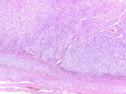 - 대한내과학회지 : 제 79 권제 4 호통권제 602 호 2010 - A B Figure 3. Microcopic findings of the adrenal gland. (A) Adrenal gland shows well defined pheochromocytoma (H&E stain, 40).