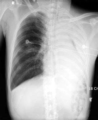 이러한중심성기도폐쇄를동반하는환자들은대부분호흡곤란, 객혈, 폐쇄성폐렴 (post obstructive pneumonia) 을동반하지만대부분진행성병기또는수술적절제가불가능한경우가많다.