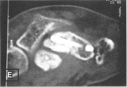 C, D. Postoperative and follwed up wrist AP X- Ray demonstrates comminuted fracture was fixated with Herbert screw