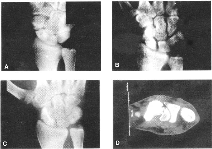 A B C D Fig. 3.- A. Preoperative wrist AP X-Ray reveals comminuted waist fracture at ulnar deviation view in 24 year old man. B. Postoperative X- Ray shows Herbert screw fixation with iliac cancellous bone grafting.
