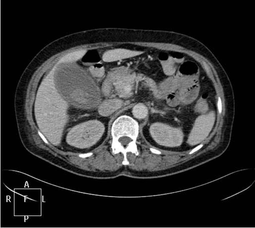 bdominal computed tomography (CT) revealed high-density hematoma within the distended gall bladder with diffuse wall