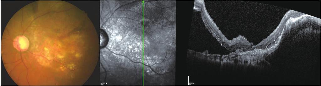 JOURNL OF RETIN Figure 2. Fundus examination and optical coherence tomography (OCT) 2 weeks after photodynamic therapy.