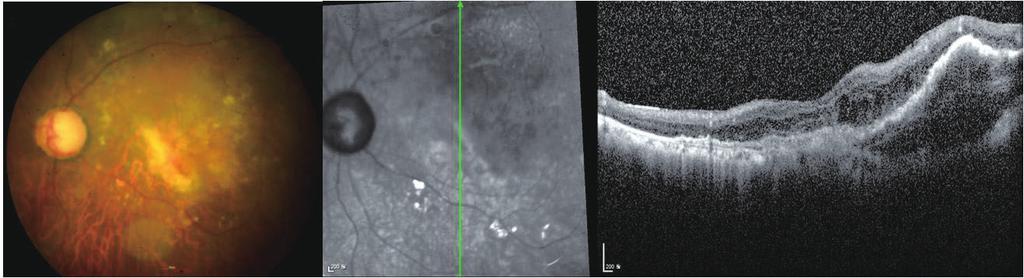 Lee TH, et al. PCV 에서 PDT 후발생한장액망막박리 Figure 3. Fundus examination () and optical coherence tomography () 3 months after reoperation.