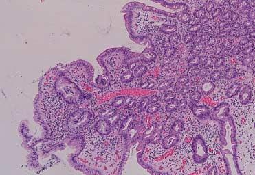 샘창자의위화생 221 A B Fig. 4. (A) A portion of the duodenal mucosa is composed of metaplastic gastric epithelial cells in addition to normal absorptive cells.