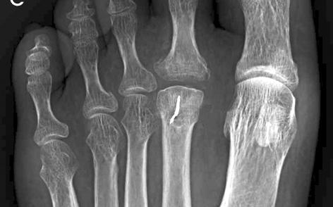 (C) Immediate postoperative radiograph of dorsal closing wedge osteotomy. The radiograph showed clean and well aligned joint, no residual osteophytes and loose body.