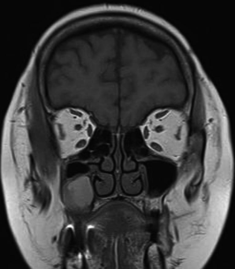 xial () and coronal () view of paranasal sinus CT scan shows about 2 cm