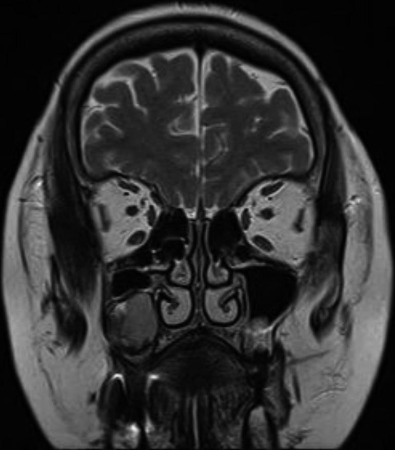 xial () and coronal () T1-weighted MRI image shows a cystic mass in the