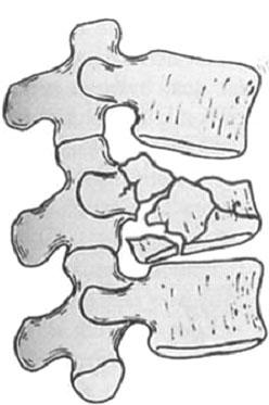 Denis three-column model of spinal stability which involves anterior (anterior 1/2