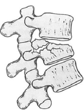 vertebra/disc and posterior longitudinal ligament), and posterior (posterior