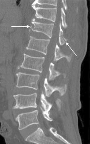 A flexion-distraction type injury at T12