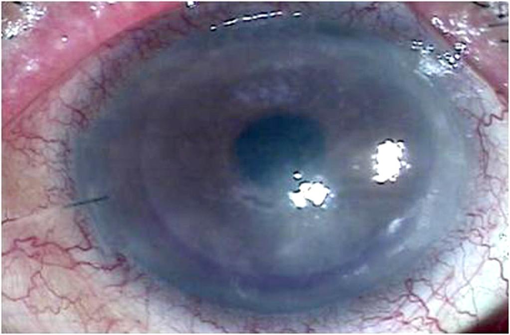 (A) Before DSAEK, pseudophakic bullous keratopathy was visible in the right eye.