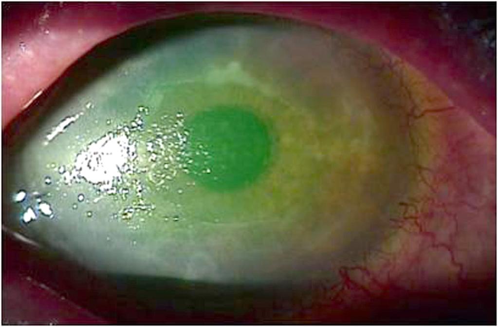 completely healed. (C) One month after surgery, corneal epithelial defects with mild corneal edema were detected.