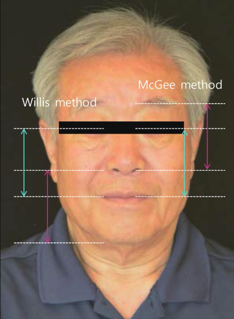 Fig. 7. Evaluation of occlusal vertical dimension using the Willis method and the McGee method.