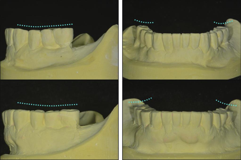 C D E Fig. 11. First provisional restorations. () Maxillary occlusal view.