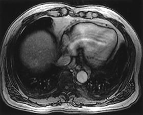 - 문희선외 6 인 : 간내원발병소없는폐전이간세포암종 - Figure 2. Initial and follow up liver MRI. (). Initial liver MRI. (). Liver MRI after 1 year.