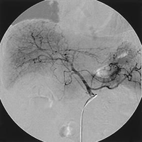 - 대한내과학회지 : 제 72 권부록 2 호 2007 - Figure 4. Hepatic angiogram performed after 9 months.