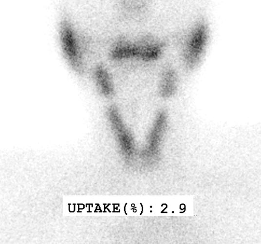 단발성대퇴골전이로진단된갑상선여포암 Fig. 3. 99m Tc-scan and thyroid ultrasonography images. (A) A thyroid scan with 99m Tc reveal diffuse thyroid uptake (2.9%) and no cold area.