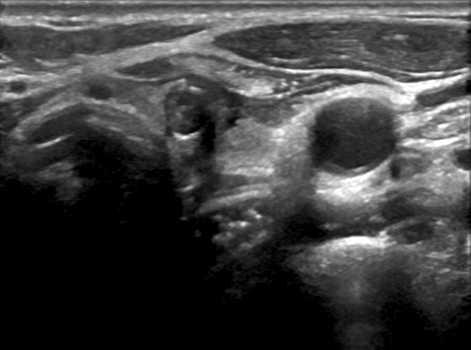 The bone scan shows the cold defect with surrounding increased uptake in the right proximal femur. 사결과는불충분한세포소견으로나왔다. 종양소파술후 3일째되는날, 낙상으로대퇴골전이부위에골절이발생하여비개방교정술및내고정술을시행하였다 (Fig. 1C).