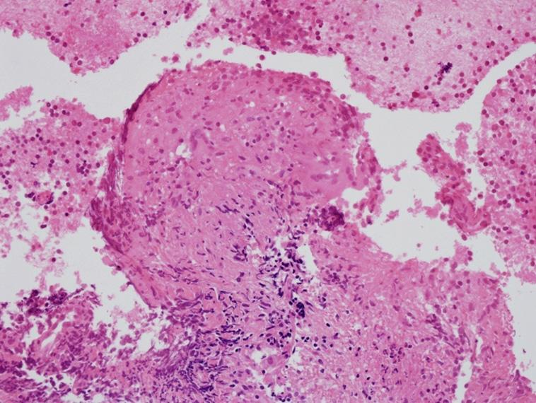 HJ Lee et al: Sarcoidosis occurred after treatment of tuberculous lymphadenitis Figure 1.