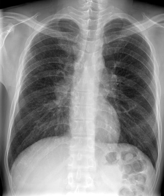 Tuberculosis and Respiratory Diseases Vol. 70. No. 5, May 2011 Figure 3. (A) Chest radiography shows bilateral hilar enlargement with diffuse bilateral nodules.