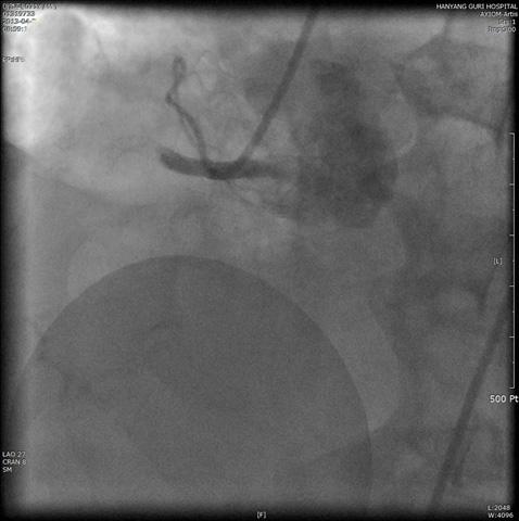 (B) Right coronary angiography shows successful revascularization without periprocedural complications after PCI.