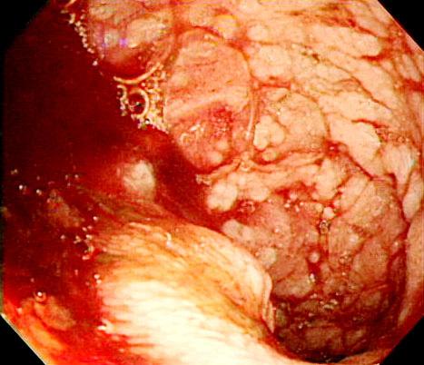 400 대한소화기내시경학회지 2007;35:399-403 Figure 1. Colonoscopic findings. (A) Multiple irregular shape aphthous ulceration is noted on the ternminal ileum. (B) Bleeding from the small bowel is noted.
