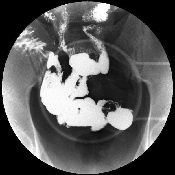 심건호외 : Retrieval of Retained Capsule due to Crohn's Enteritis with Double Balloon Enteroscopy 401 Figure 3. Small bowel series findings. (A) The capsule is retained at the jejunal stricture.