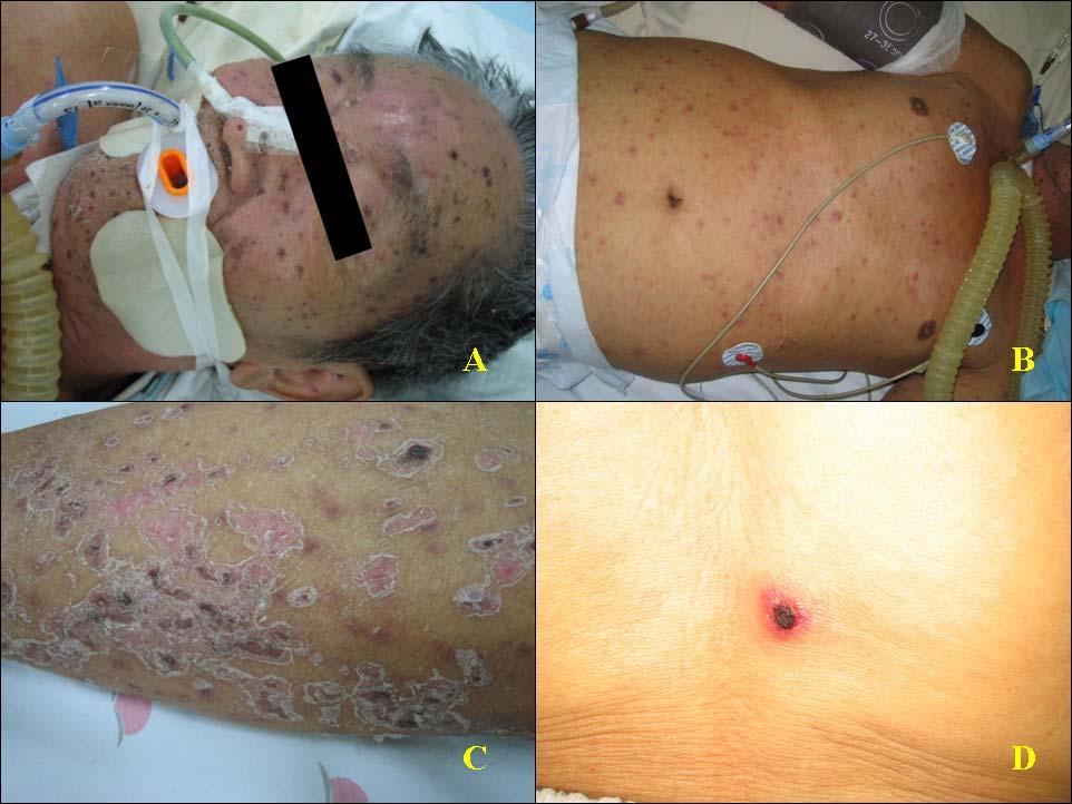 KH Ryu et al: A case of ARDS overlooked tsutstugamushi disease that presented as simple cutaneous lesions 서는현재까지 4예가발표되었다 7-9.